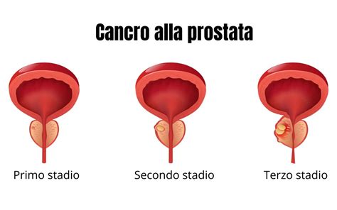 tumore prostata .